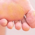 How to Remove Calluses From Feet Permanently: an Ankle Specialist's Proven Methods