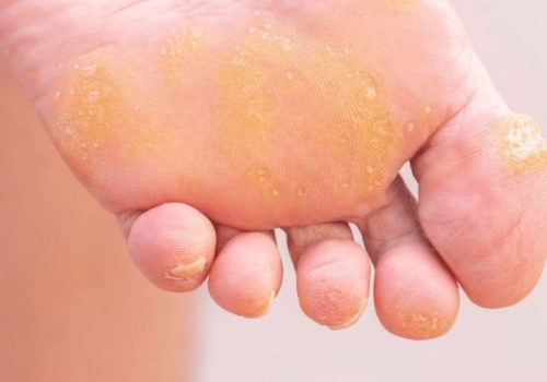 How to Remove Calluses From Feet Permanently: an Ankle Specialist's Proven Methods